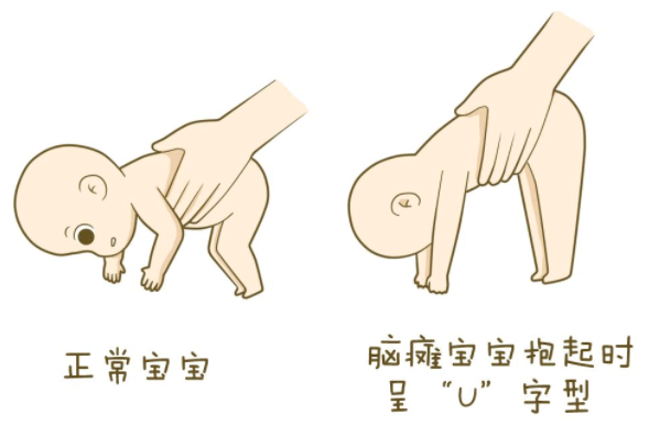 重度窒息可能会导致脑瘫，引起脑瘫的其他原因又有哪些呢？