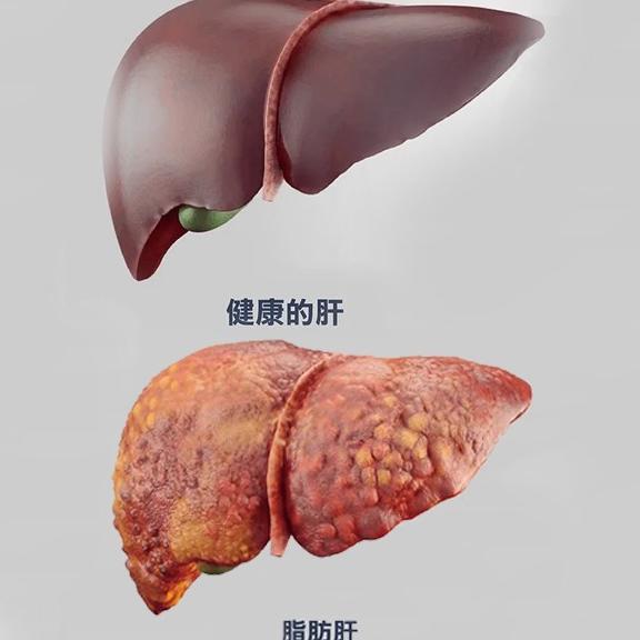 体检时发现脂肪肝要怎么处理才好的最快呢？