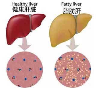 生活常识篇-老年人脂肪肝应该怎样调养