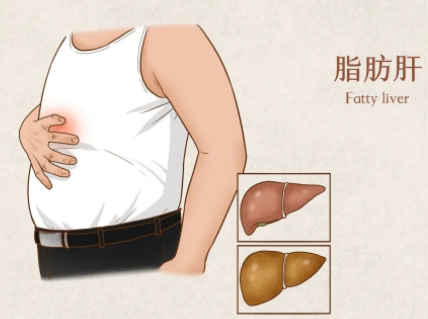 老年人患有脂肪肝之后要怎么调养才更合理呢？