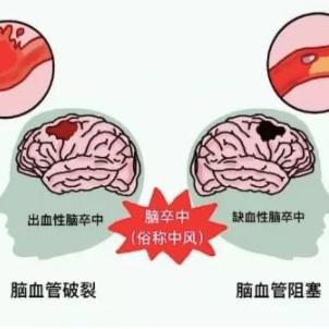 泰安圣康医院医生讲述脑中风的发病前兆有哪些